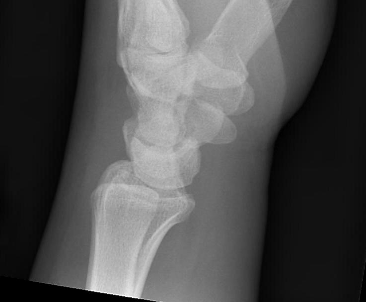 Scaphoid Fracture Lateral